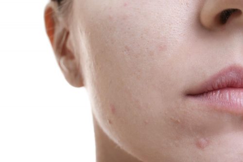 A photograph showing belmished skin relating to deep cleanse treatment